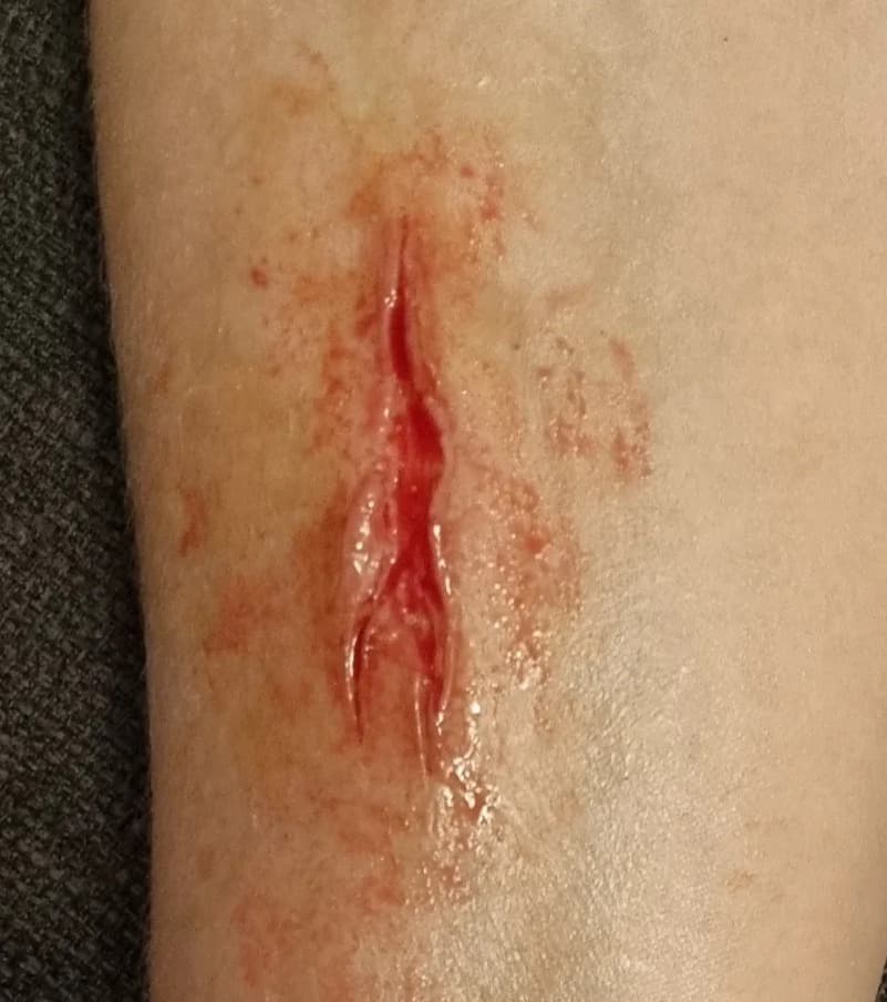 Tiefe Stichverletzung