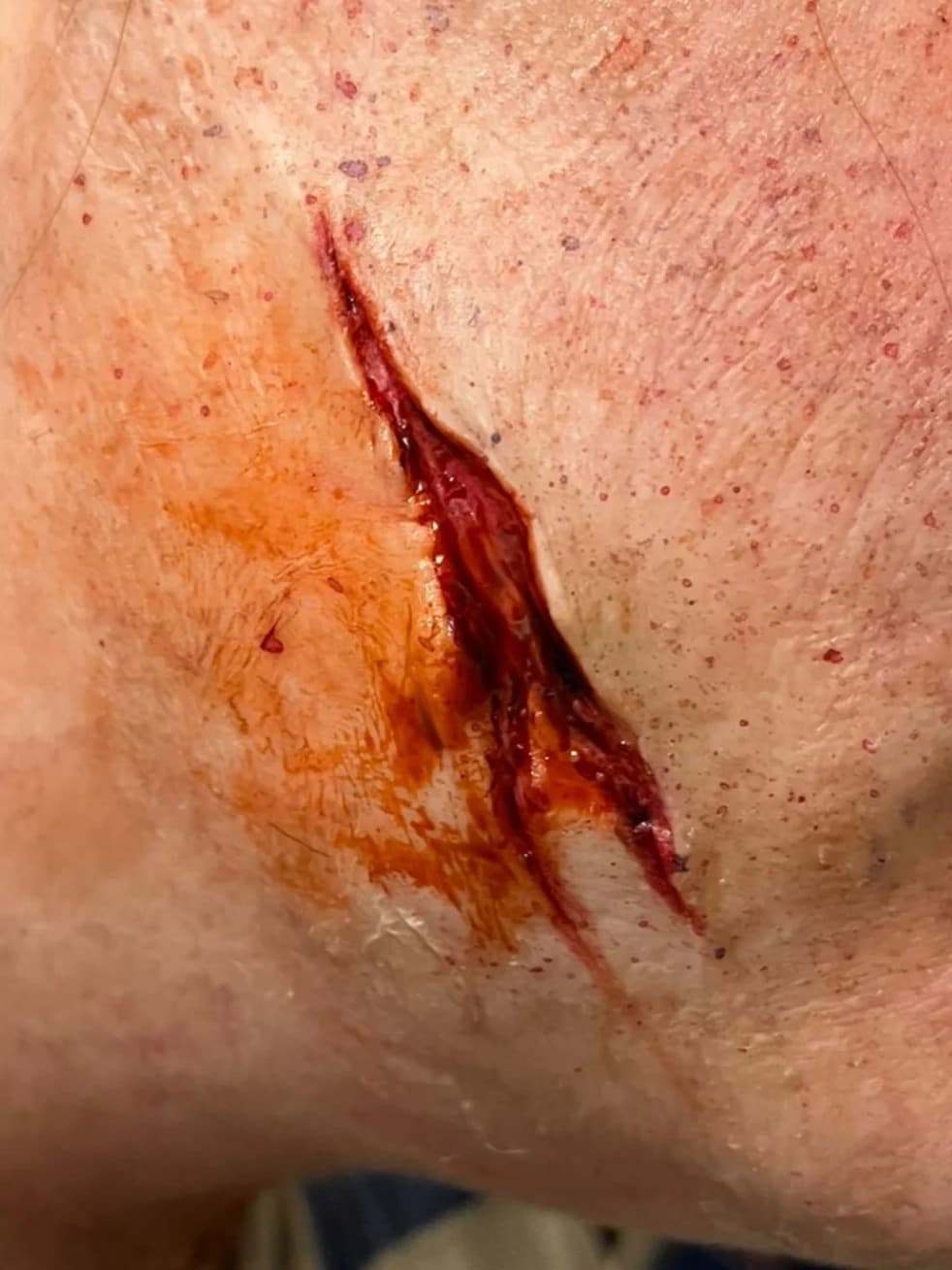 Tiefe Stichverletzung
