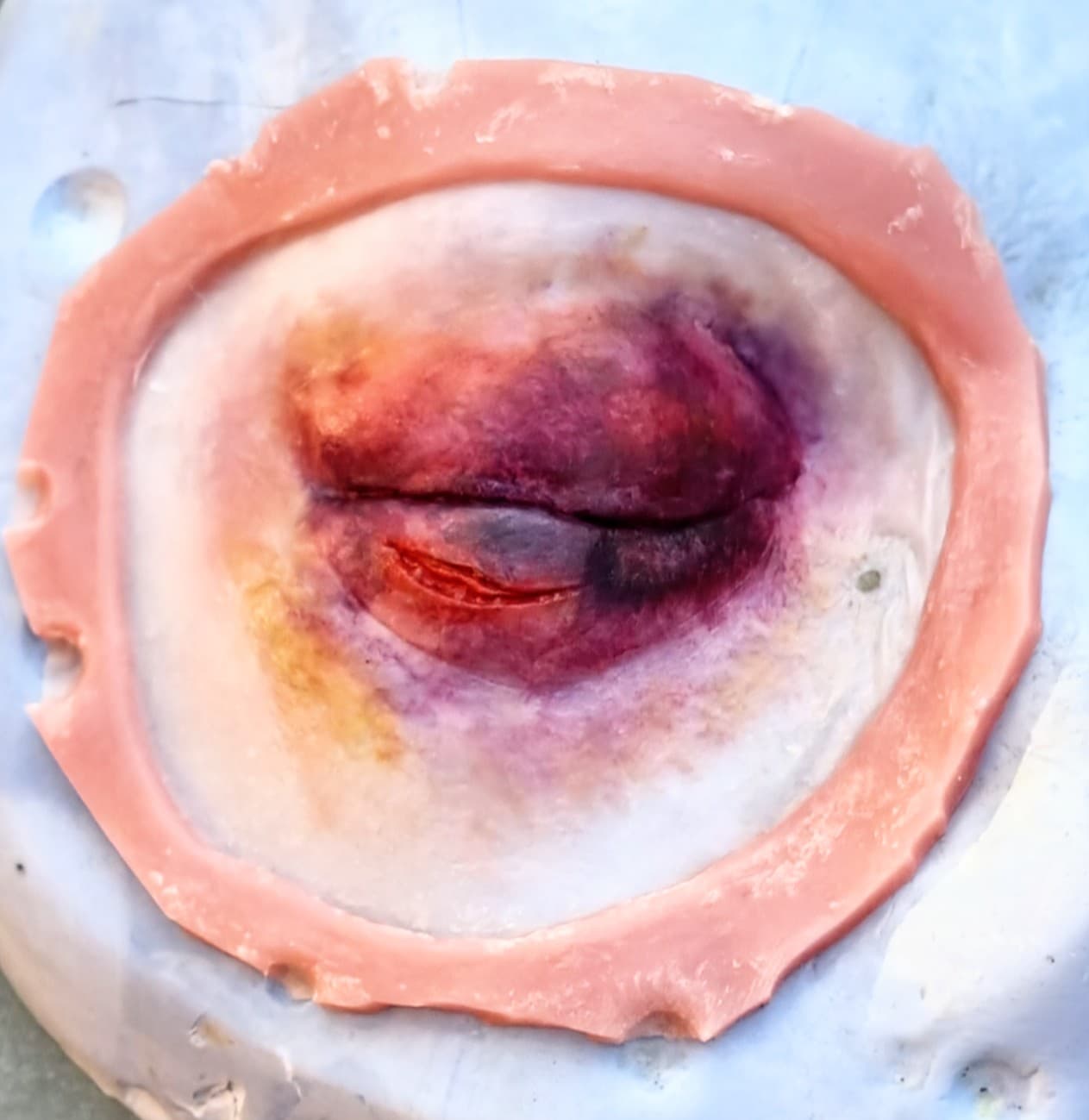 Geschwollenes Blaues Auge