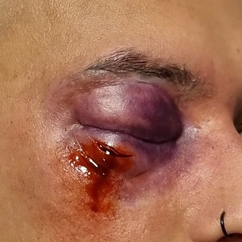 Geschwollenes Blaues Auge