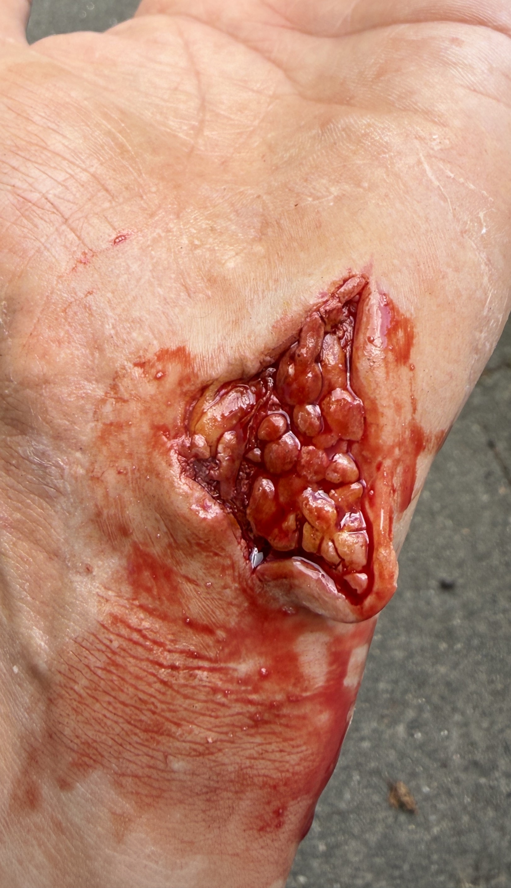 Deep Open Flesh Wound